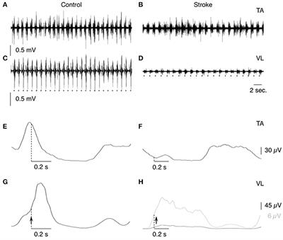 Music Restores Propriospinal Excitation During Stroke Locomotion